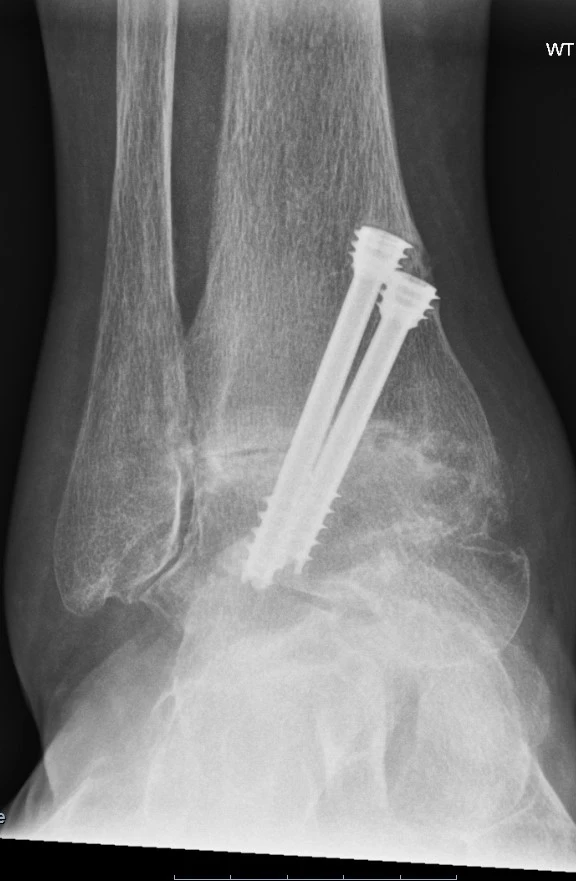 Arthroscopic Ankle Fusion