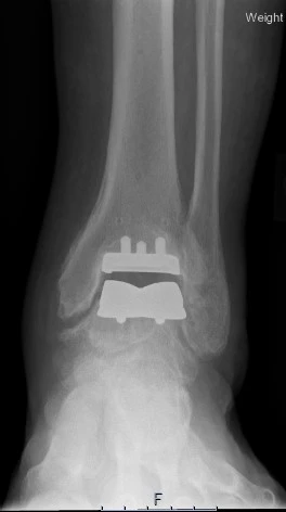 Total Ankle replacement after